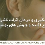 از بین بردن جای جوش با محصولات تخصصی