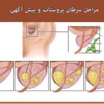 مراحل سرطان پروستات و پیش‌آگهی آن؛ آیا قابل درمان است؟