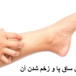 علت خارش ساق پا و زخم شدن آن چیست؟ درمان خانگی خارش ساق پا