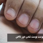 علت پوست پوست شدن دور ناخن