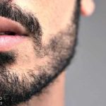 عوارض کاشت ریش و سبیل چقدر جدی است؟ بعد از چند وقت برطرف میشود؟