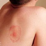 جوش پشت کمر نشانه چیست و چگونه درمان می شود؟ – مجله سلامت دکترتو