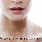 علت لکه های سفید روی پوست کمبود کدام ویتامین در بدن است؟ درمان خانگی